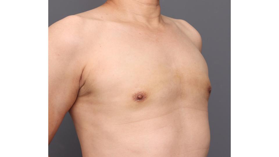 男性のお悩みー女性化乳房